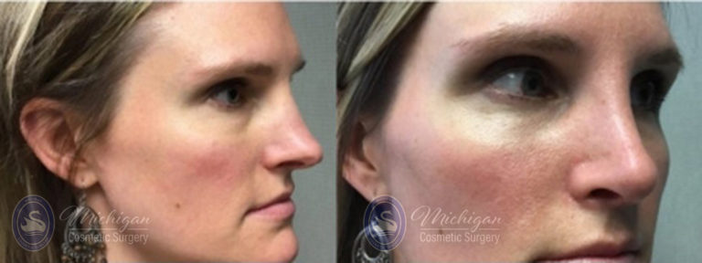 Rhinoplasty Before and After Photo by Dr. Awada in Southfield Michigan