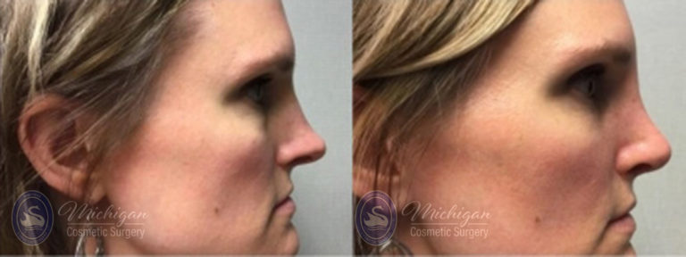 Rhinoplasty Before and After Photo by Dr. Awada in Southfield Michigan
