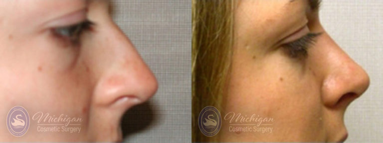 Rhinoplasty Before and After Photo by Dr. Awada in Southfield Michigan