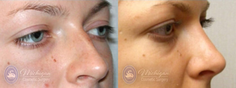 Rhinoplasty Before and After Photo by Dr. Awada in Southfield Michigan
