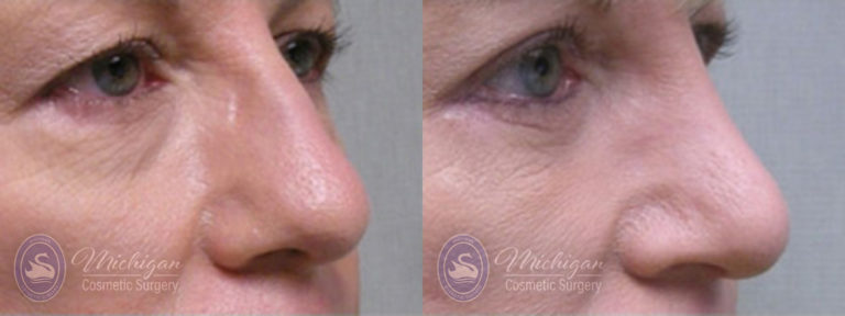 Rhinoplasty Before and After Photo by Dr. Awada in Southfield Michigan