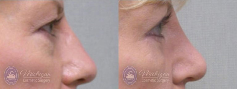 Rhinoplasty Before and After Photo by Dr. Awada in Southfield Michigan