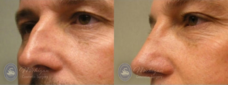 Rhinoplasty Before and After Photo by Dr. Awada in Southfield Michigan