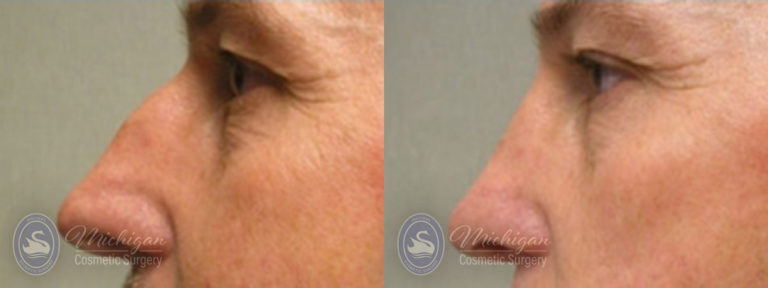 Rhinoplasty Before and After Photo by Dr. Awada in Southfield Michigan