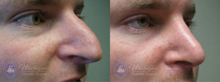 Rhinoplasty Before and After Photo by Dr. Awada in Southfield Michigan