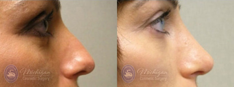 Rhinoplasty Before and After Photo by Dr. Awada in Southfield Michigan