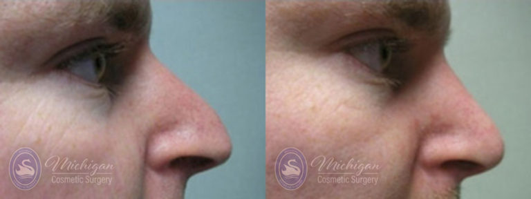 Rhinoplasty Before and After Photo by Dr. Awada in Southfield Michigan