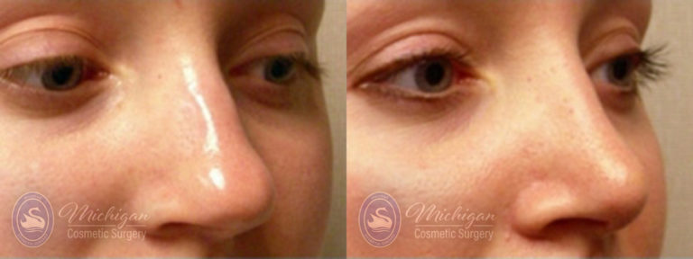 Rhinoplasty Before and After Photo by Dr. Awada in Southfield Michigan