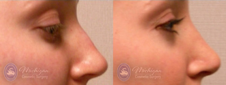 Rhinoplasty Before and After Photo by Dr. Awada in Southfield Michigan