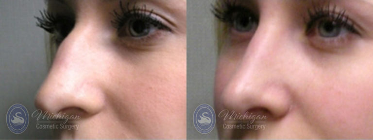 Rhinoplasty Before and After Photo by Dr. Awada in Southfield Michigan