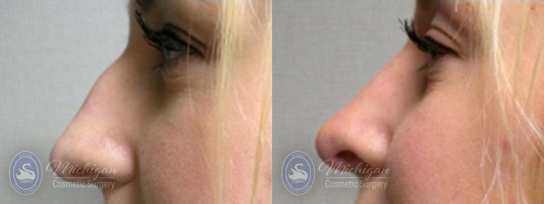 Rhinoplasty Before and After Photo by Dr. Awada in Southfield Michigan