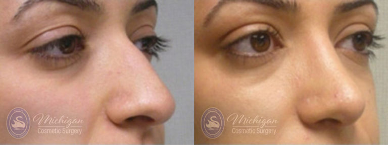 Rhinoplasty Before and After Photo by Dr. Awada in Southfield Michigan