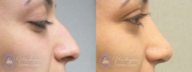 Rhinoplasty Before and After Photo by Dr. Awada in Southfield Michigan