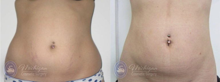 Stretchmark Removal Before and After Photo by Dr. Awada in Southfield Michigan
