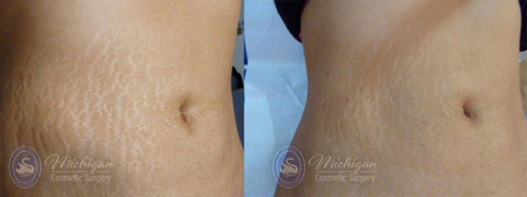 Stretchmark Removal Before and After Photo by Dr. Awada in Southfield Michigan