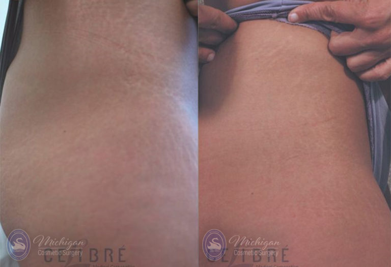 Stretchmark Removal Before and After Photo by Dr. Awada in Southfield Michigan