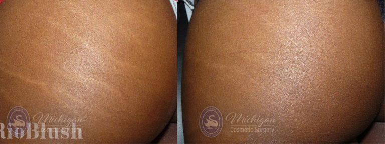 Stretchmark Removal Before and After Photo by Dr. Awada in Southfield Michigan