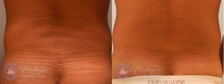 Stretchmark Removal Before and After Photo by Dr. Awada in Southfield Michigan