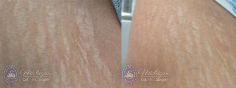 Stretchmark Removal Before and After Photo by Dr. Awada in Southfield Michigan