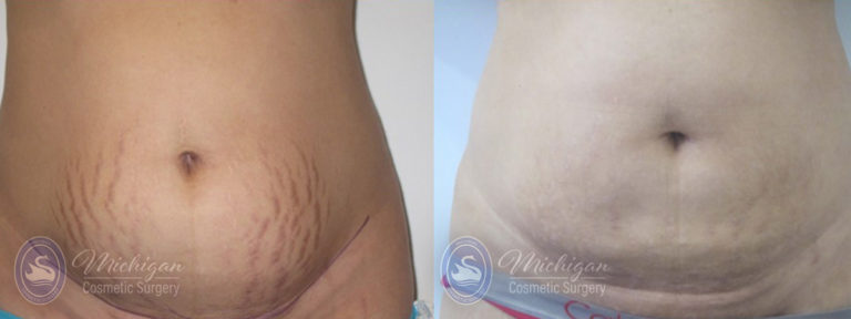Stretchmark Removal Before and After Photo by Dr. Awada in Southfield Michigan