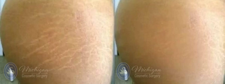 Stretchmark Removal Before and After Photo by Dr. Awada in Southfield Michigan