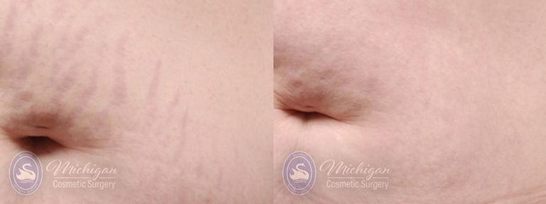 Stretchmark Removal Before and After Photo by Dr. Awada in Southfield Michigan