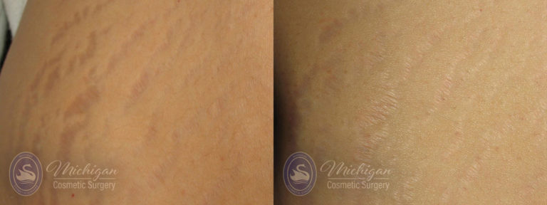 Stretchmark Removal Before and After Photo by Dr. Awada in Southfield Michigan