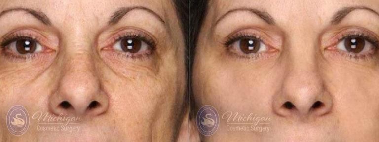 Thermi Smooth Before and After Photo by Dr. Awada in Southfield Michigan