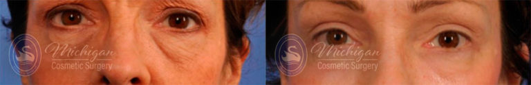 Thermi Smooth Before and After Photo by Dr. Awada in Southfield Michigan