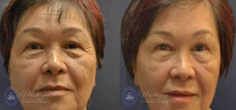 Thermi Smooth Before and After Photo by Dr. Awada in Southfield Michigan