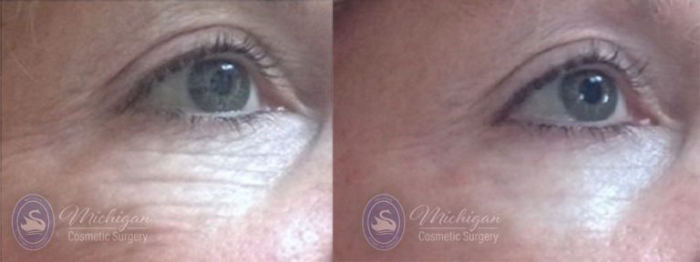Thermi Smooth Before and After Photo by Dr. Awada in Southfield Michigan
