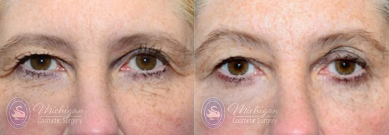 Thermi Smooth Before and After Photo by Dr. Awada in Southfield Michigan