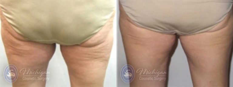 Thermi Smooth Before and After Photo by Dr. Awada in Southfield Michigan
