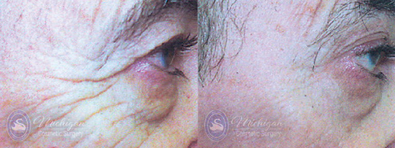 Thermi Smooth Before and After Photo by Dr. Awada in Southfield Michigan