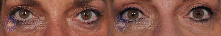 Thermi Smooth Before and After Photo by Dr. Awada in Southfield Michigan