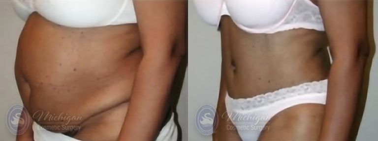 Tummy Tuck Before and After Photo by Dr. Awada in Southfield Michigan