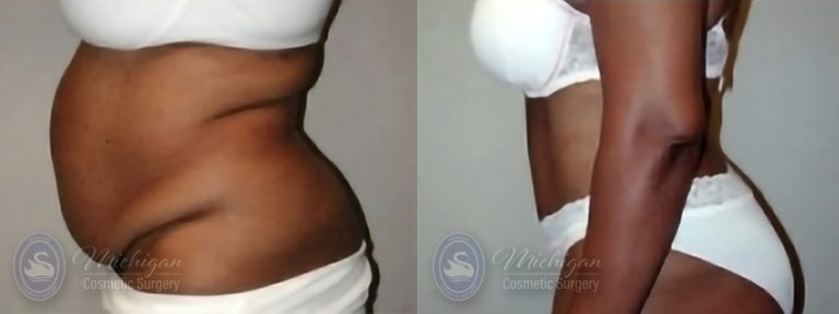 Tummy Tuck Before and After Photo by Dr. Awada in Southfield Michigan