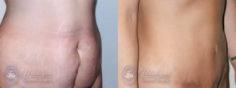 Tummy Tuck Before and After Photo by Dr. Awada in Southfield Michigan