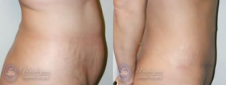 Tummy Tuck Before and After Photo by Dr. Awada in Southfield Michigan