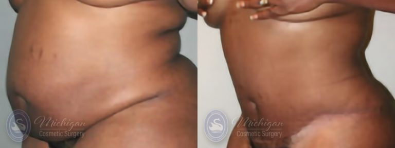 Tummy Tuck Before and After Photo by Dr. Awada in Southfield Michigan