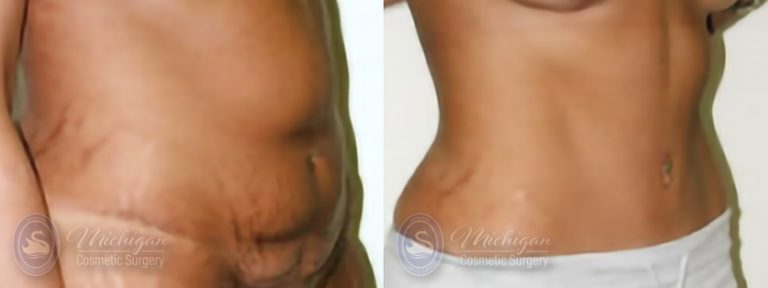 Tummy Tuck Before and After Photo by Dr. Awada in Southfield Michigan