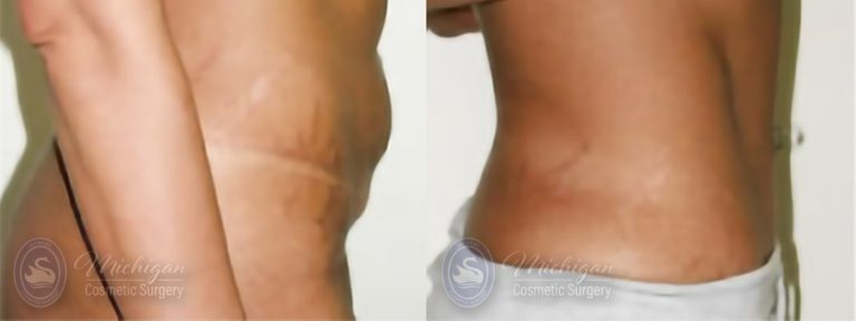 Tummy Tuck Before and After Photo by Dr. Awada in Southfield Michigan