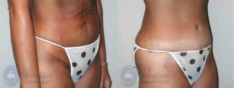 Tummy Tuck Before and After Photo by Dr. Awada in Southfield Michigan
