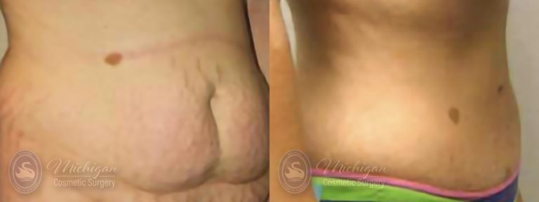 Tummy Tuck Before and After Photo by Dr. Awada in Southfield Michigan