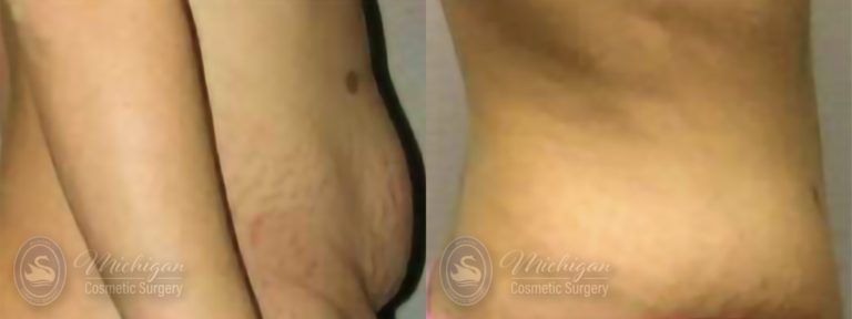 Tummy Tuck Before and After Photo by Dr. Awada in Southfield Michigan