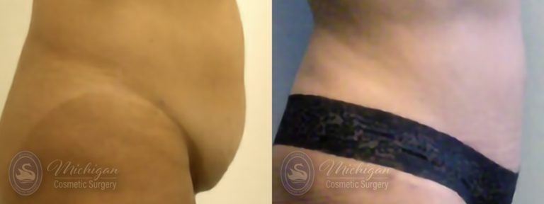 Tummy Tuck Before and After Photo by Dr. Awada in Southfield Michigan