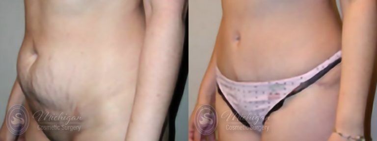 Tummy Tuck Before and After Photo by Dr. Awada in Southfield Michigan