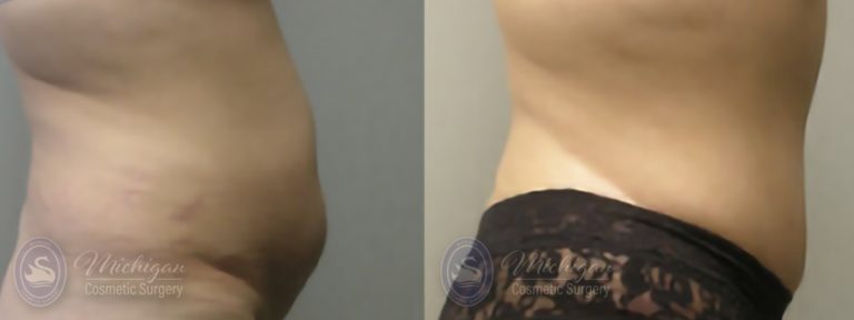 Tummy Tuck Before and After Photo by Dr. Awada in Southfield Michigan