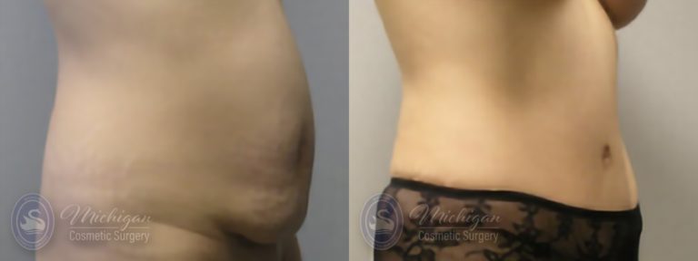 Tummy Tuck Before and After Photo by Dr. Awada in Southfield Michigan