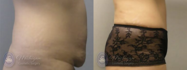 Tummy Tuck Before and After Photo by Dr. Awada in Southfield Michigan